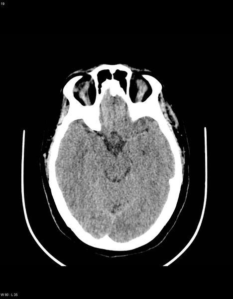 File:Astroblastoma (Radiopaedia 39792-42216 Axial non-contrast 18).jpg