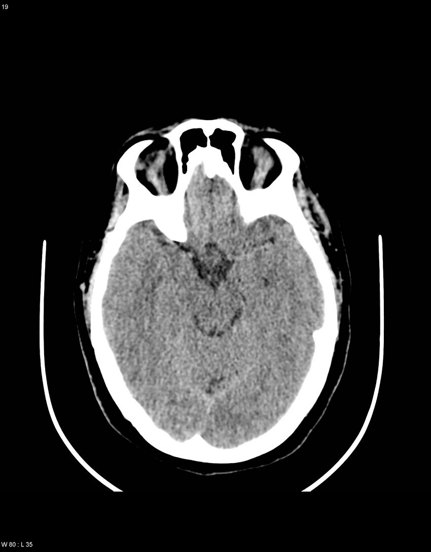 Astroblastoma (Radiopaedia 39792-42216 Axial non-contrast 18).jpg