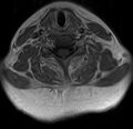 Astrocytoma - spinal cord (Radiopaedia 69769-79758 Axial T1 C+ 13).jpg