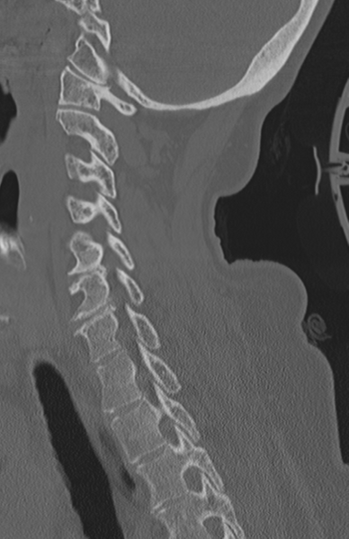 File:Atlanto-axial subluxation (Radiopaedia 36610-38176 Sagittal bone window 50).png