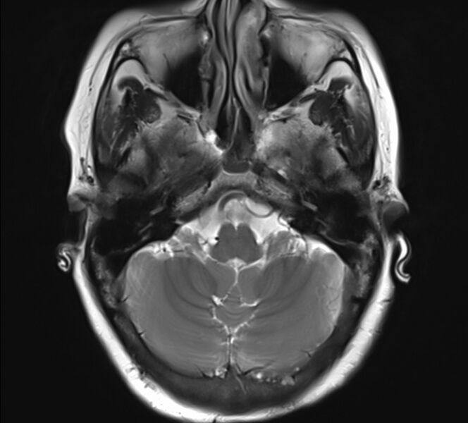 File:Atlanto-occipital assimilation with basilar invagination (Radiopaedia 70122-80157 Axial T2 5).jpg