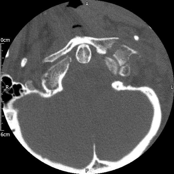 File:Atlas fracture with Currarino type A congenital defect (Radiopaedia 71747-82144 Axial bone window 24).jpg