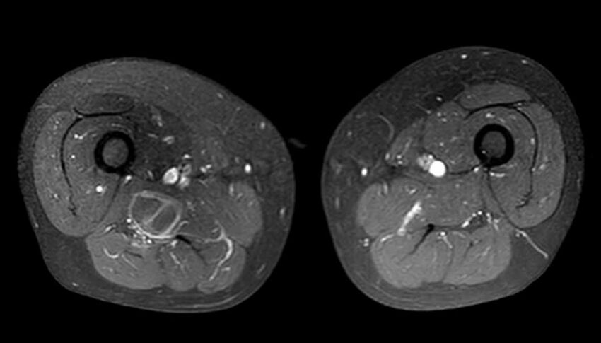 Atypical lipomatous tumor - thigh (Radiopaedia 68975-78734 Axial T1 C+ fat sat 49).jpg