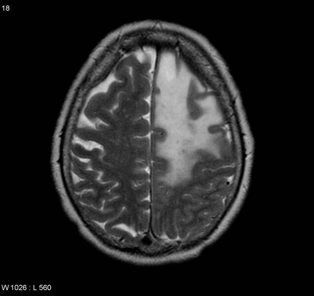 File:Atypical meningioma (WHO grade II) (Radiopaedia 5273-7016 Axial T2 11).jpg