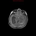 Atypical teratoid rhabdoid tumor (Radiopaedia 10712-11183 Axial FLAIR 10).jpg