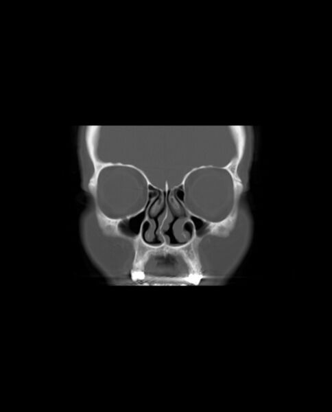 File:Automastoidectomy with labyrinthine fistula (Radiopaedia 84143-99411 Coronal non-contrast 19).jpg