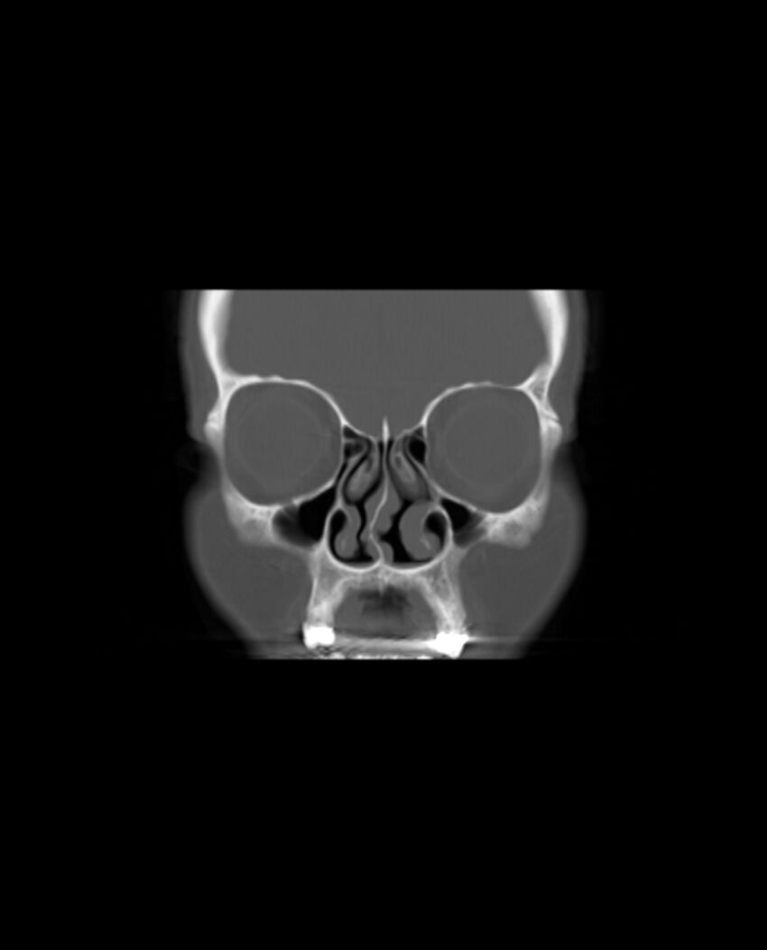 Automastoidectomy with labyrinthine fistula (Radiopaedia 84143-99411 Coronal non-contrast 19).jpg