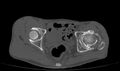 Avascular necrosis of the left hip (Radiopaedia 75068-86125 Axial bone window 41).jpg