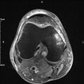Avulsion fracture of the fibular head (Radiopaedia 74804-85808 Axial PD fat sat 16).jpg