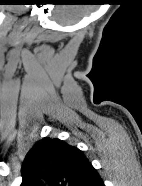File:Axis peg fracture (type 3) and atlas lateral mass (type 4) fracture (Radiopaedia 37474-39324 D 7).png