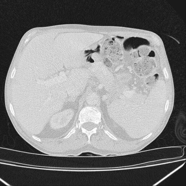 File:Azygos lobe (Radiopaedia 38259-40275 Axial lung window 84).jpg