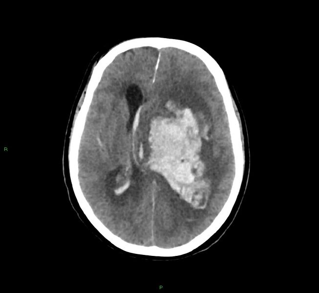 File:Basal ganglia hemorrhage (Radiopaedia 58775-66008 Axial non-contrast 30).jpg
