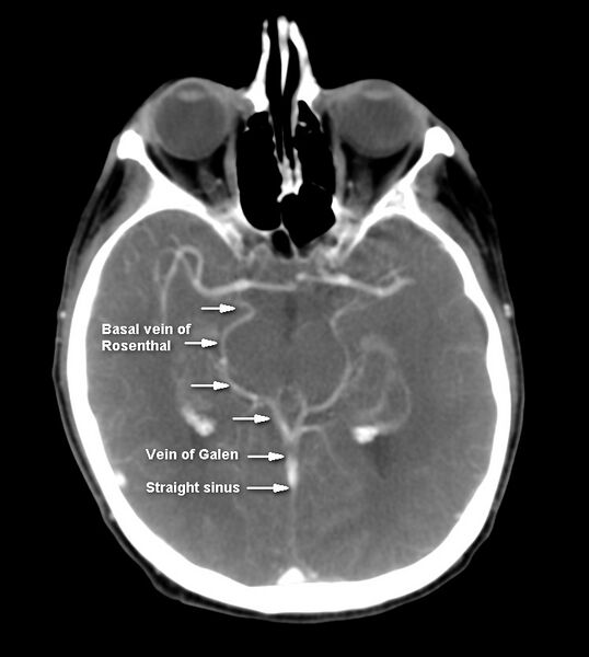 File:Basal vein of Rosenthal (annotated image) (Radiopaedia 36173).jpg