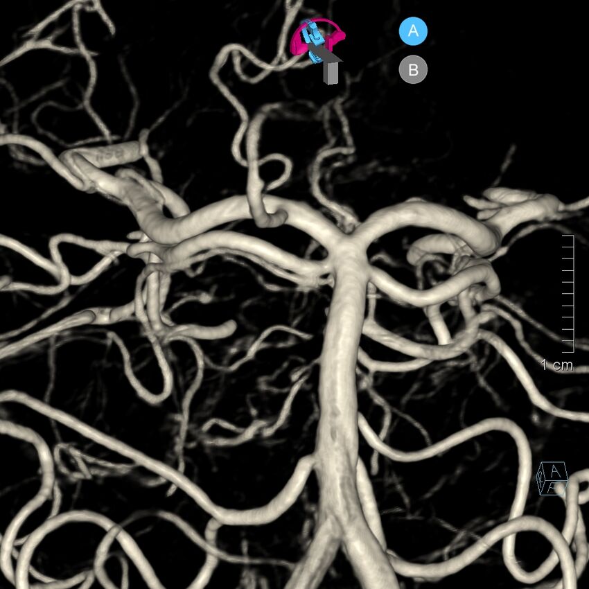 Basilar artery perforator aneurysm (Radiopaedia 82455-97734 3D view left VA 118).jpg