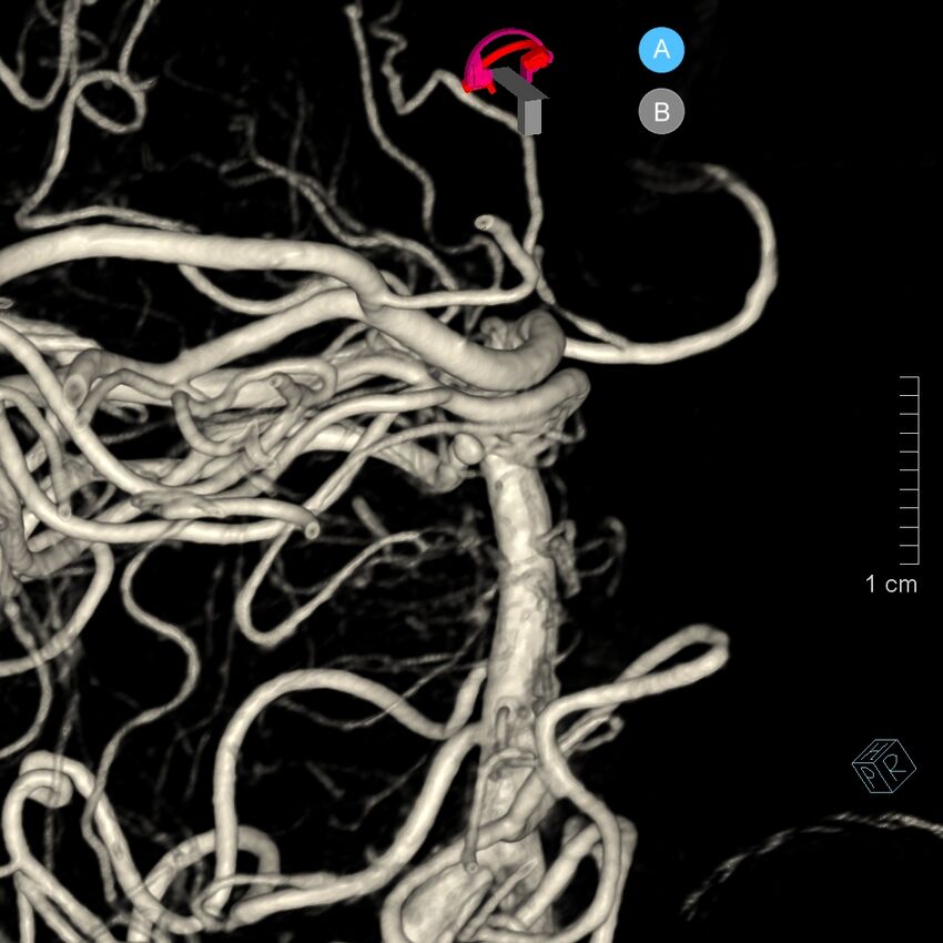 Basilar artery perforator aneurysm (Radiopaedia 82455-97734 3D view left VA 145).jpg