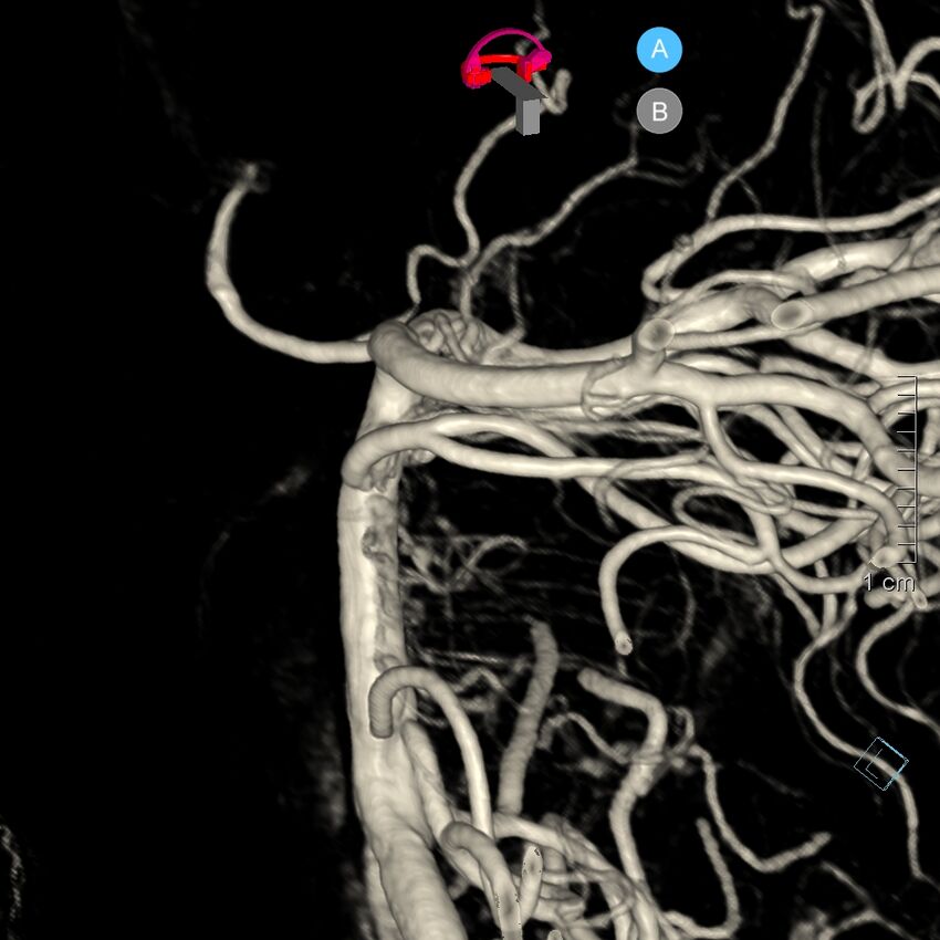 Basilar artery perforator aneurysm (Radiopaedia 82455-97734 3D view left VA 180).jpg