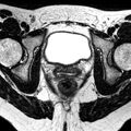 Bicornuate uterus (Radiopaedia 11104-11492 Axial T2 11).jpg