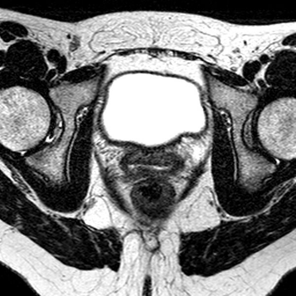 File:Bicornuate uterus (Radiopaedia 11104-11492 Axial T2 11).jpg