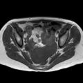 Bicornuate uterus (Radiopaedia 61974-70046 Axial T1 27).jpg