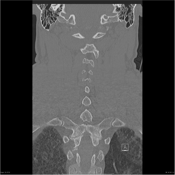 File:Bilateral cervical ribs (Radiopaedia 25868-26017 Coronal bone window 35).jpg
