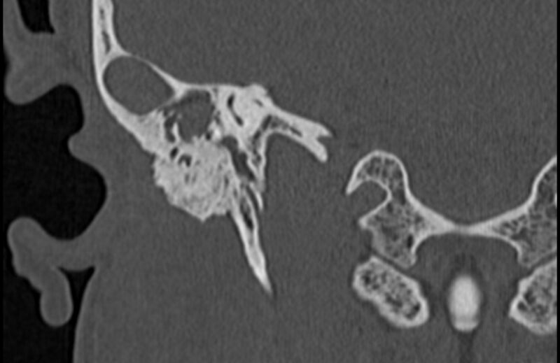 File:Bilateral cholesteatoma (Radiopaedia 54898-61172 Coronal bone window 57).jpg