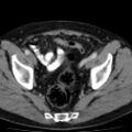 Bilateral direct inguinal herniae (Radiopaedia 17016-16719 B 11).jpg