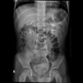 Bilateral duplex kidneys with left-sided uterocoele (Radiopaedia 20811-20725 Frontal 2).jpg