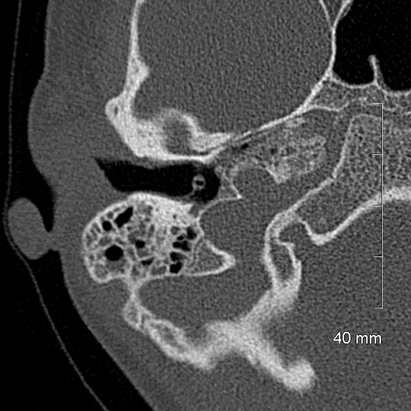 File:Bilateral grommets (Radiopaedia 47710-52404 Axial bone window 24).jpg