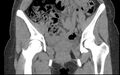 Bilateral mature cystic ovarian teratoma (Radiopaedia 88821-105592 Coronal non-contrast 4).jpg