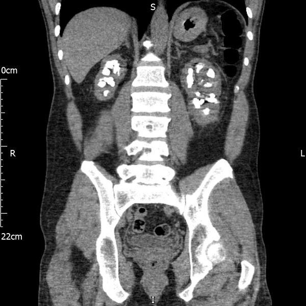 File:Bilateral medullary nephrocalcinosis with ureteric calculi (Radiopaedia 71269-81569 Coronal non-contrast 47).jpg