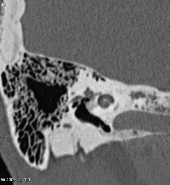 File:Bilateral otosclerosis with left stapes prosthesis (Radiopaedia 5567-7302 Coronal bone window 6).jpg
