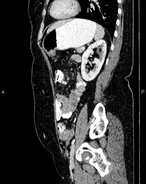 File:Bilateral ovarian serous cystadenocarcinoma (Radiopaedia 86062-101989 E 62).jpg