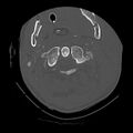 Bilateral perched facets with cord injury (Radiopaedia 45587-49713 Axial bone window 28).jpg