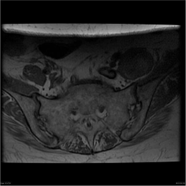 File:Bilateral psoas hematomas (Radiopaedia 24057-24280 T1 12).jpg
