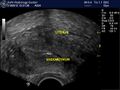 Bilateral tubal block and hydrosalpinx (Radiopaedia 23086-23117 A 3).jpg