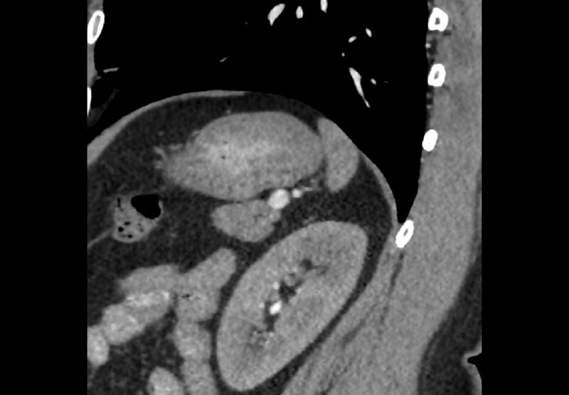 File:Bilateral urolithiasis with incidentally detected splenic artery aneurysm and left inferior vena cava (Radiopaedia 44467-48127 Ob. Sag. C+ Art. 11).jpg