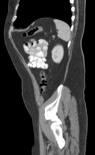 File:Bleeding duodenal ulcer and adenomyomatosis of gallbladder (Radiopaedia 61834-69861 C 85).jpg