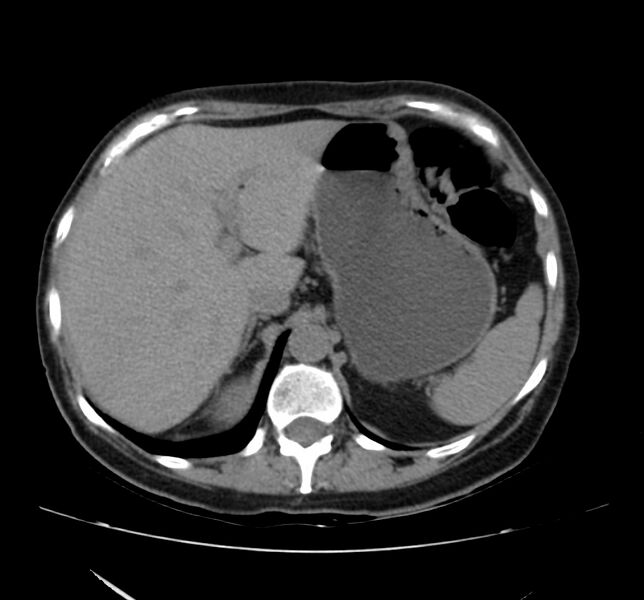 File:Bosniak renal cyst - type IV (Radiopaedia 22929-22953 Axial non-contrast 11).jpg