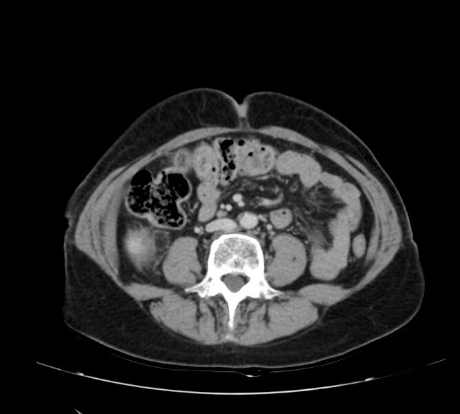File:Bosniak renal cyst - type IV (Radiopaedia 22929-22953 C 36).jpg