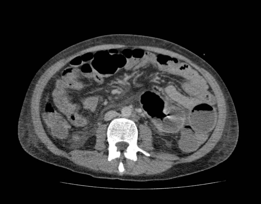 Bowel lymphoma complicated by bleeding after therapy (Radiopaedia 55601-62110 C 44).jpg