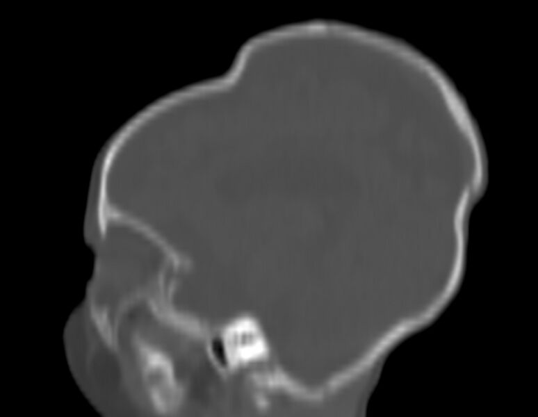 File:Brachycephaly (bi-coronal and bi-lambdoid synostosis) (Radiopaedia 55048-61413 Sagittal bone window 21).jpg
