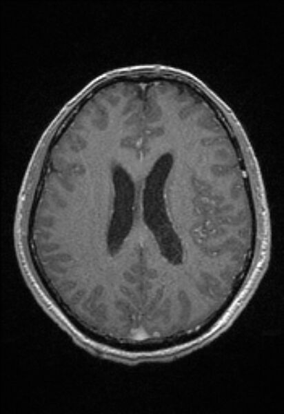 File:Brain abscess with ventriculitis (Radiopaedia 85703-101495 Axial T1 C+ 113).jpg