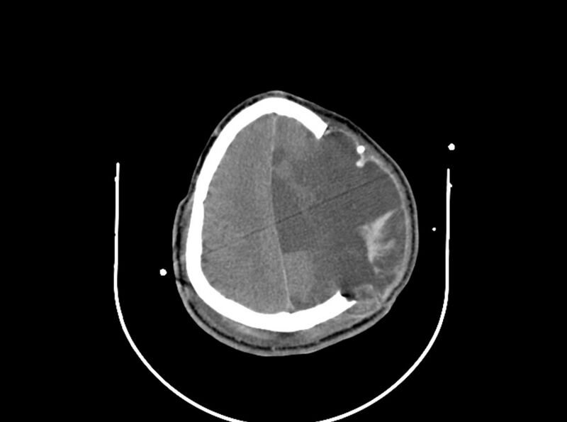 File:Brain injury by firearm projectile (Radiopaedia 82068-96087 B 143).jpg