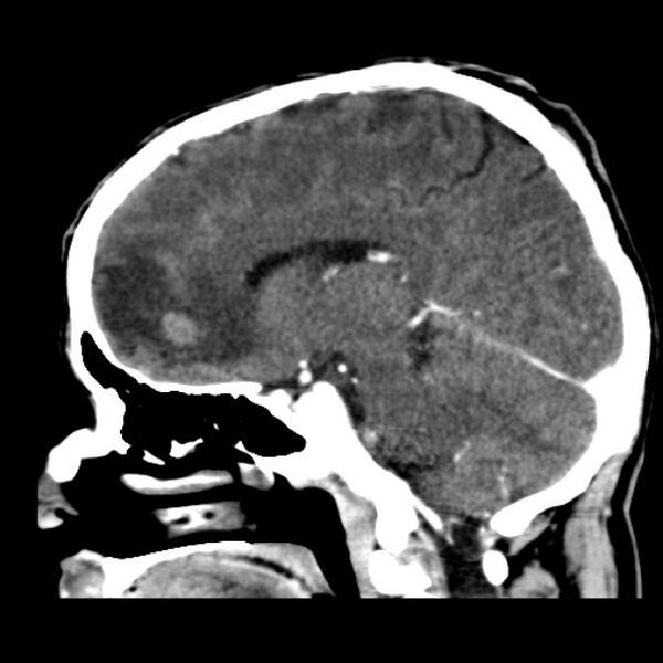 File:Brain metastases from lung cancer (Radiopaedia 24480-24781 C+ delayed 33).jpg