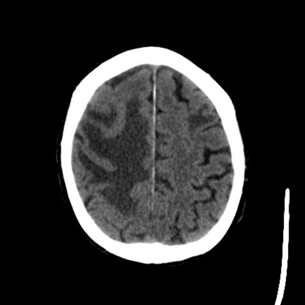 File:Brain metastases from lung cancer (Radiopaedia 27849-28092 Axial non-contrast 36).jpg