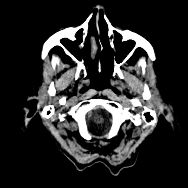 File:Brain metastases from lung cancer (Radiopaedia 27849-28092 Axial non-contrast 4).jpg