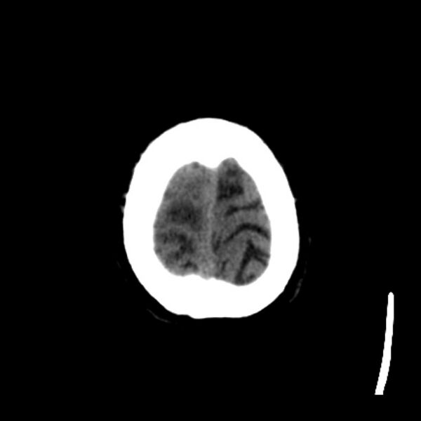 File:Brain metastases from lung cancer (Radiopaedia 27849-28092 Axial non-contrast 43).jpg