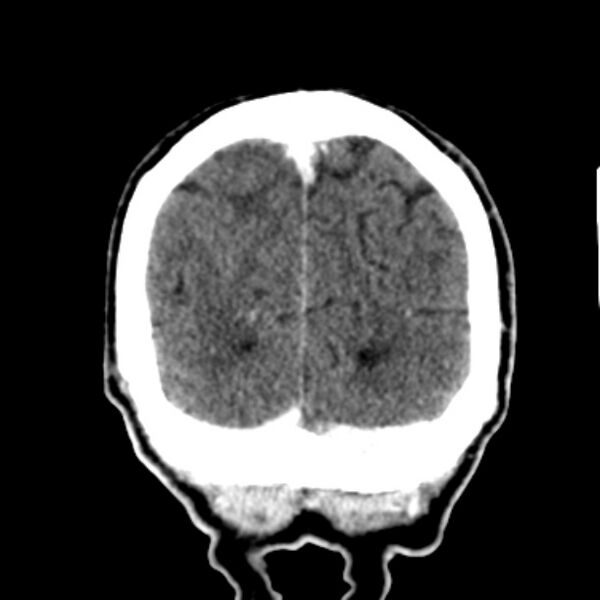 File:Brain metastases from lung cancer (Radiopaedia 27849-28092 Coronal C+ delayed 59).jpg