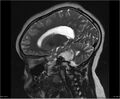 Brainstem glioma (Radiopaedia 21819-21775 Sagittal T2 9).jpg
