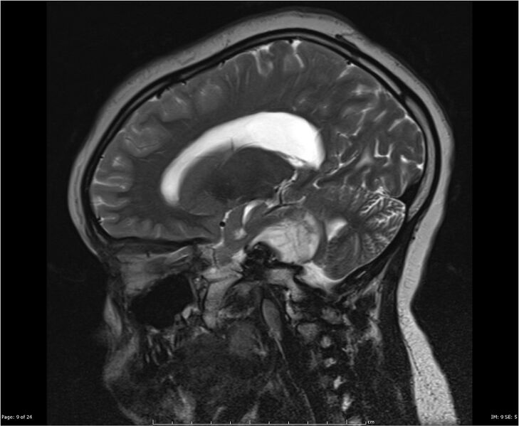 File:Brainstem glioma (Radiopaedia 21819-21775 Sagittal T2 9).jpg